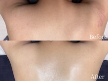 ラティエ(Latier)/月一肌管理ハーブピーリング