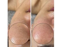 レーヌ(Reine)/毛穴＋ピコジェット＋臍帯原液