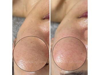 レーヌ(Reine)/毛穴＋ピコジェット＋臍帯原液