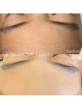 アール(ar.)/プラズマ顔脱毛（1回）