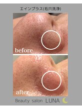 ルナ(LUNA)/エインプラス(毛穴洗浄)