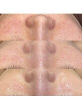 レシェルサロン(Lechelle Salon)/ハーブピーリング＋ダーマエステ