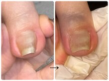 ソラ(SOLA.)/巻き爪ケア