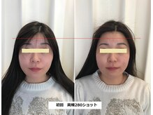 ナチュレアンドメディカ(Nature&Medica)/【たるみor小顔】ソフウェーブLT