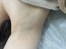 ナノハナ/鹿沼市全身脱毛美容室ナノハナ