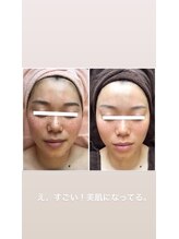 アーニャビューティー(Anya Beauty)/高濃度美容液導入