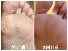 フォーチューン/足裏角質ケア♪
