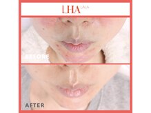 アンジュマリー/★韓国発！ララピールで肌管理★