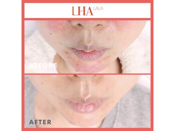 アンジュマリー/★韓国発！ララピールで肌管理★