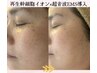 【肌改善人気No.1】シミケア修復幹細胞7％導入跡ケア・美白 ¥15,800→¥9,800