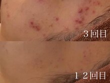 ホワイトアクア 岐阜店(WHITE AQUA)/ハーブピーリング/岐阜/ニキビ