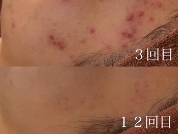 ホワイトアクア 岐阜店(WHITE AQUA)/ハーブピーリング/岐阜/ニキビ