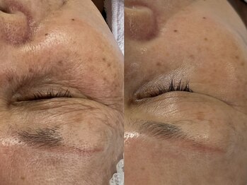 フェリス(FELIZ)/歳を重ねて出来たシワにはコレ!