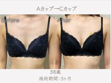ハリスタ 京橋院(HARISTA)/BEFORE AFTER【バストアップ】