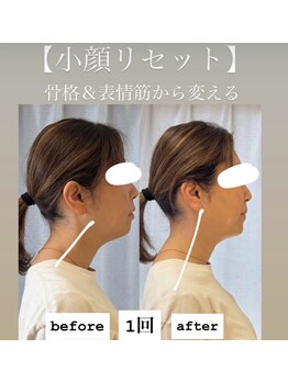 グラースア(grace a)/【小顔ケア】