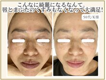 ポモナ 横浜馬車道店(Pomona)/シミはもちろんくすみも大変身