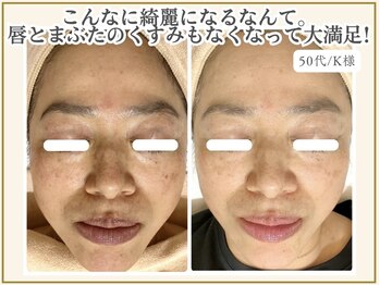 ポモナ 横浜馬車道店(Pomona)/シミはもちろんくすみも大変身