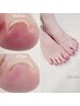 巻き爪でネイルを諦めている方へ｜補正＋ケア＋ジェルネイル