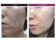 パーフェクトフェイスビューティー 梅田店(PERFECT FACE BEAUTY)/ディレイアコスメ（3種）使用