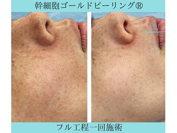 リメイククリニカルビューティー(Remake clinical beauty)/酸化と糖化