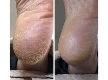 厚木 海老名 巻き爪矯正センター/事例【ドイツ式フットケア】