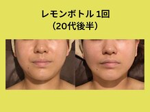 アユアラングレース/レモンボトル2回