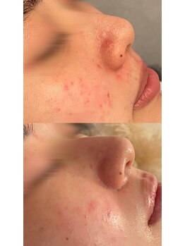 ビジュープラス(Bijou+)/剥離無しハーブピーリング