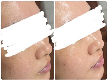 カピリナ(ka pilina)/陶肌ピールで毛穴の奥まで浸透★