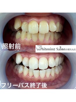 ホワイトニングサロン 京都烏丸店/ホワイトニング施術例