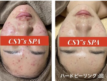 ヘルスアンドビューティー シーズスパ(CSY's SPA)/ハーブピーリングでニキビケア