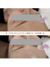 ディアー(Dear)/プラズマパールリフト