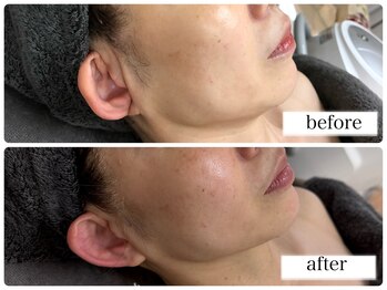 シェミー(CHEZ MEE)/小顔/二重顎/ほうれい線/たるみ