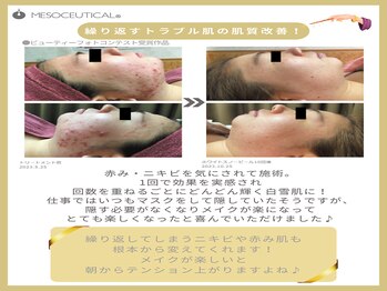 ホロホロ(holoholo)/本気のニキビ毛穴ケア