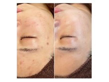 ベルファム(Belle femme)/エクソソームハーブピーリング