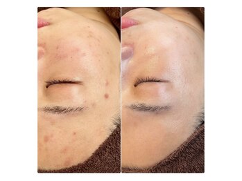 ベルファム(Belle femme)/エクソソームハーブピーリング