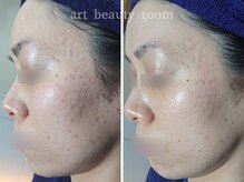 アート ビューティールーム(art beauty room)/XE'LHA PEEL （セラピール） 1回