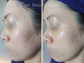 アート ビューティールーム(art beauty room)/XE'LHA PEEL (セラピール) 1回