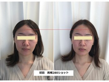 ナチュレアンドメディカ(Nature&Medica)/【たるみor小顔】ソフウェーブLT