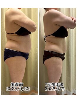 クールスパ(COOL SPA)/50代女性お腹症例
