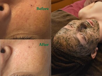 ランファビューティー(蘭花Beauty)の写真/モニター募集♪たるみ改善【ハ-ブピ-リング+リジュランフォト★¥7700】シミ・くすみなどの肌トラブルにも!