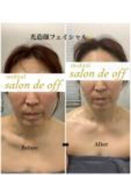 メディカルサロンドオフ 堺東店(medical salon de off)/光造顔フェイシャル★ &nbsp;施術前後