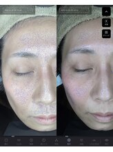 ジャスミン(Jasmin)/肌質診断機BA