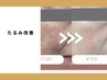 【たるみ・小顔ケア】たるみ改善ケア