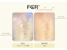 ハーバル 新宿店(HERBAL)/最強★韓国FCRハーブピーリング