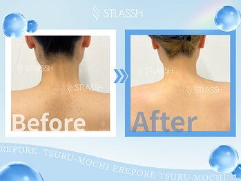 ストラッシュ 豊田店(STLASSH)/施術例：背中