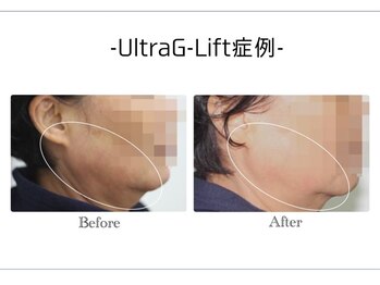 アンドエピ(&epi)/韓国痩身フェイシャル症例写真４