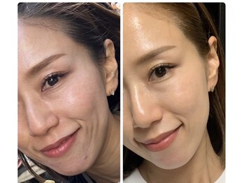 ラグ(LUXU)/ラミネーションピール