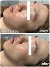 エンチャント(ENCHANT)/メンズ★タラソ×ハイドラ施術