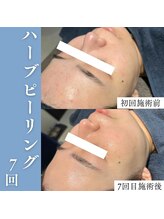 エミーニー(emiiny)/ぷつぷつ肌荒れ卒業