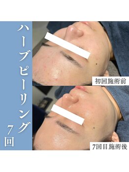 エミーニー(emiiny)/ぷつぷつ肌荒れ卒業